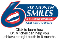 Roscommon Dentist Six Month Braces
